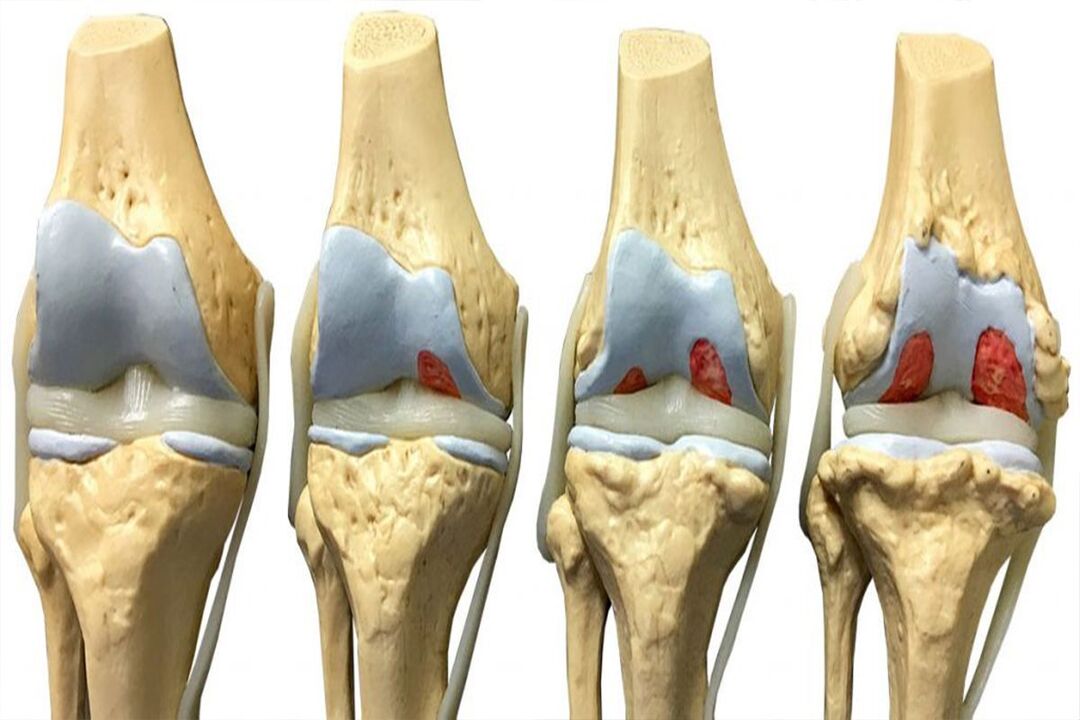 stage of development of arthrosis