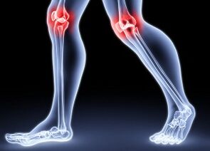 Reason -Secondary development of knee arthrosis