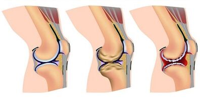The developmental stage of the arthrosis of the knee joint