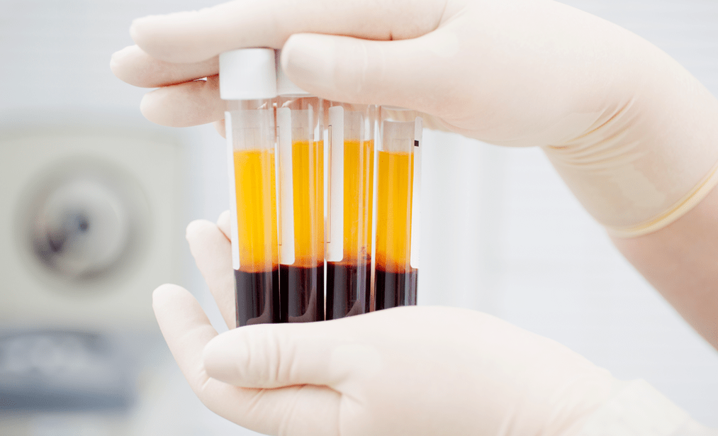 Platelet-rich plasma for PRP therapy for arthrosis